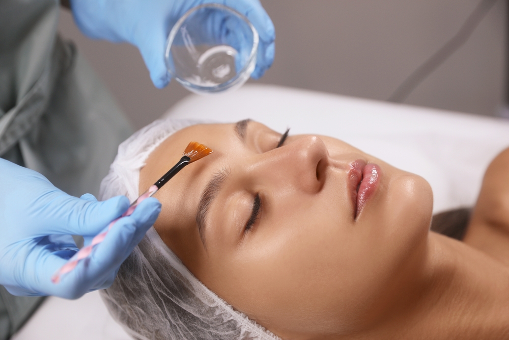 Benefits of Chemical Peels for Skin Discoloration and Scarring