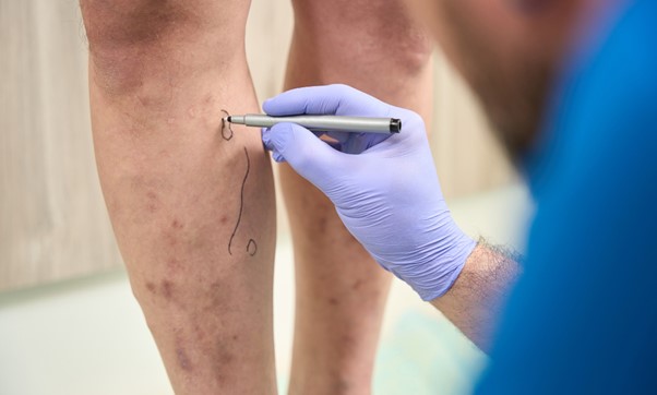 Minimally Invasive Treatment Options for Varicose Veins