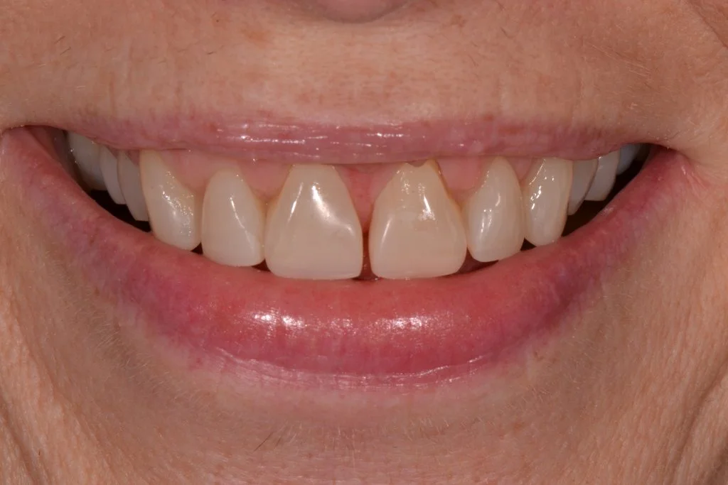 The Role of Dental Bonding in Cosmetic Dentistry