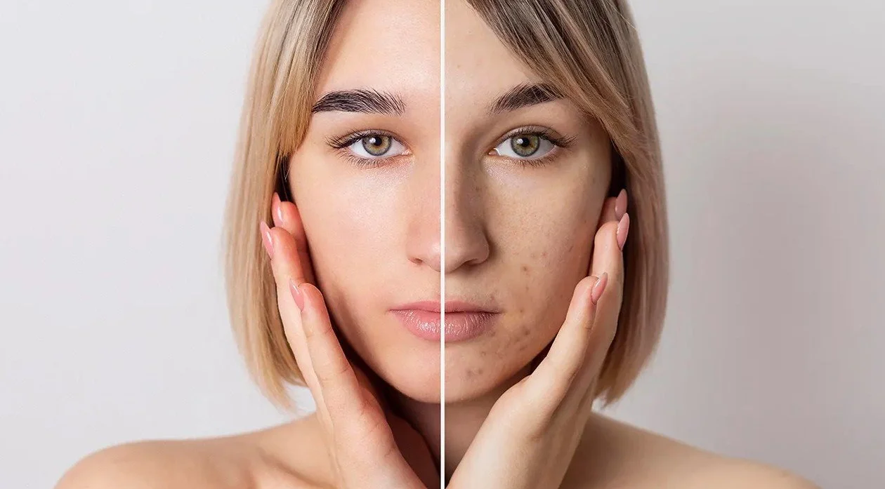 Exploring the Role of a Dermatologist in Managing Acne and Other Skin Conditions