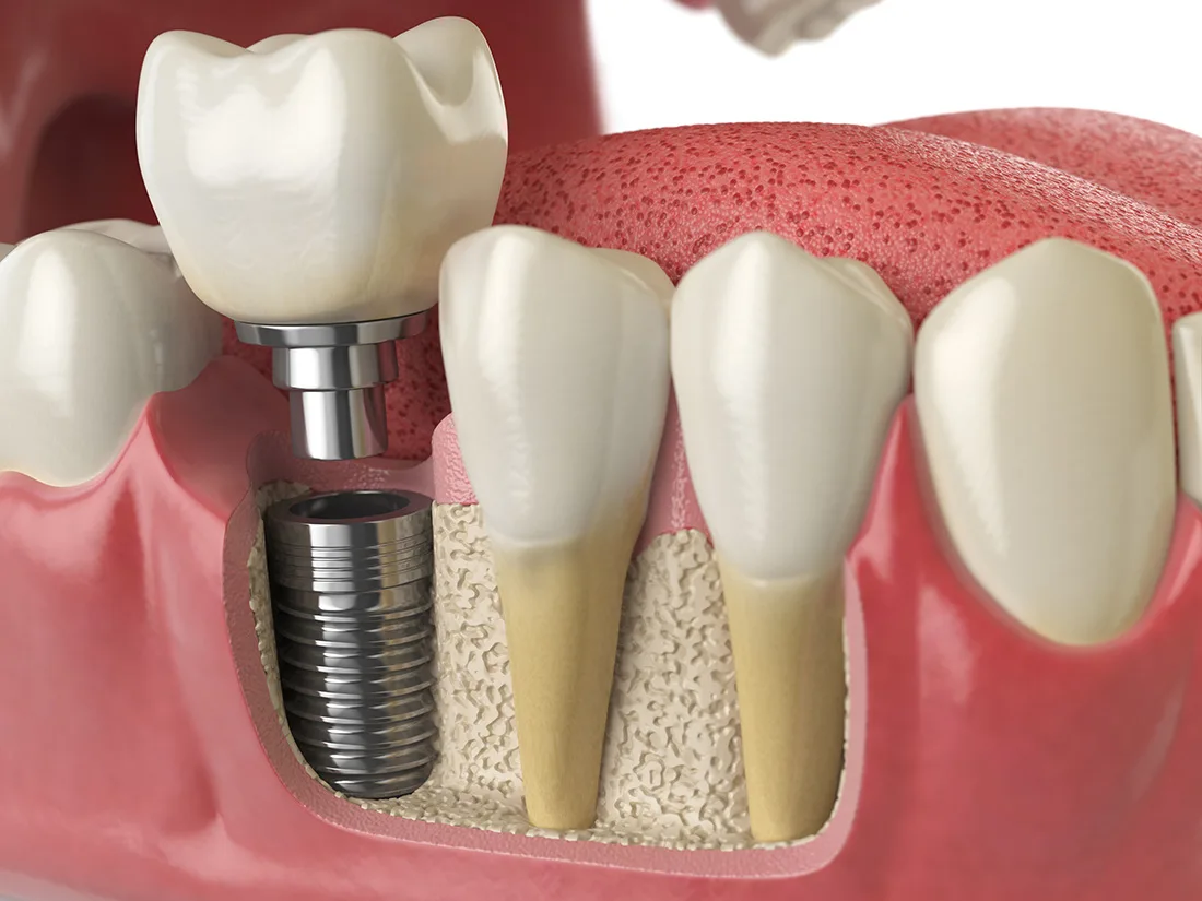 What Are Enodental Implants and How Are They Used in Dentistry?