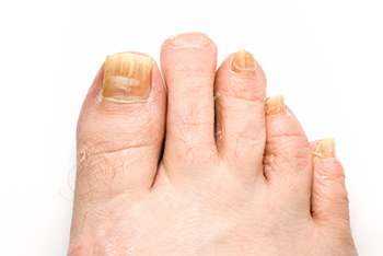 When To See a Doctor for an Ingrown Toenail