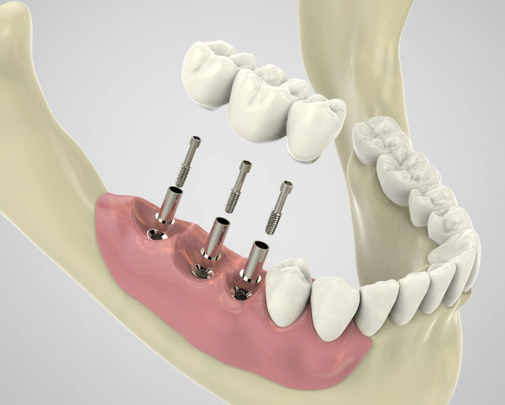 Who Can Get Dental Implants?
