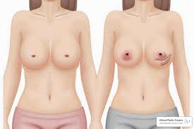 How a Plastic Surgeon Helps With Breast Lift Procedures